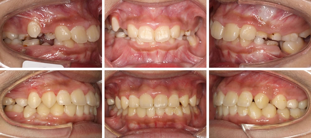 子どもの叢生・八重歯の矯正治療例