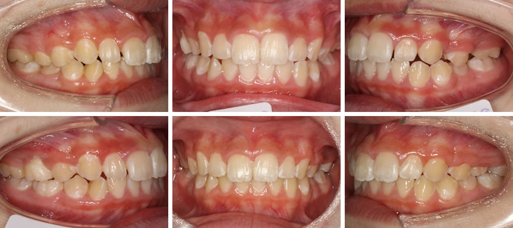 子どものすきっ歯の矯正治療例