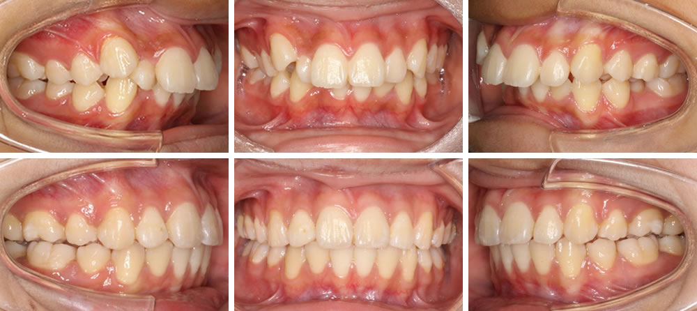 上顎前突(出っ歯)の矯正治療例