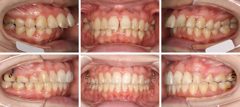 上顎前突(出っ歯)の矯正治療例