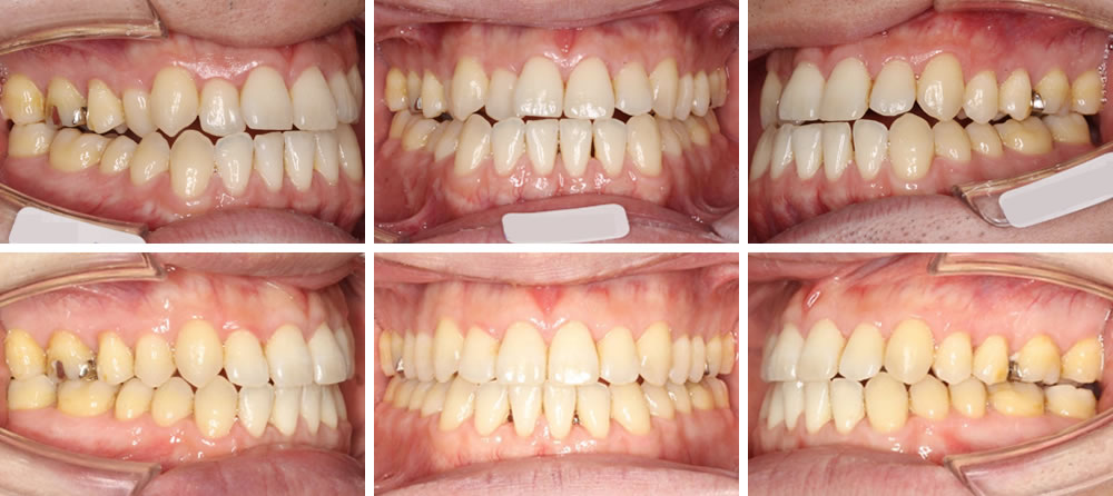 開咬(前歯が開く)の矯正治療例