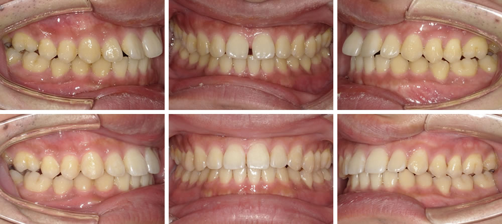 すきっ歯(空隙)の矯正治療例