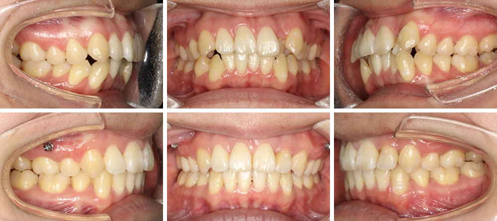 八重歯・叢生(凸凹の歯並び)の矯正治療例