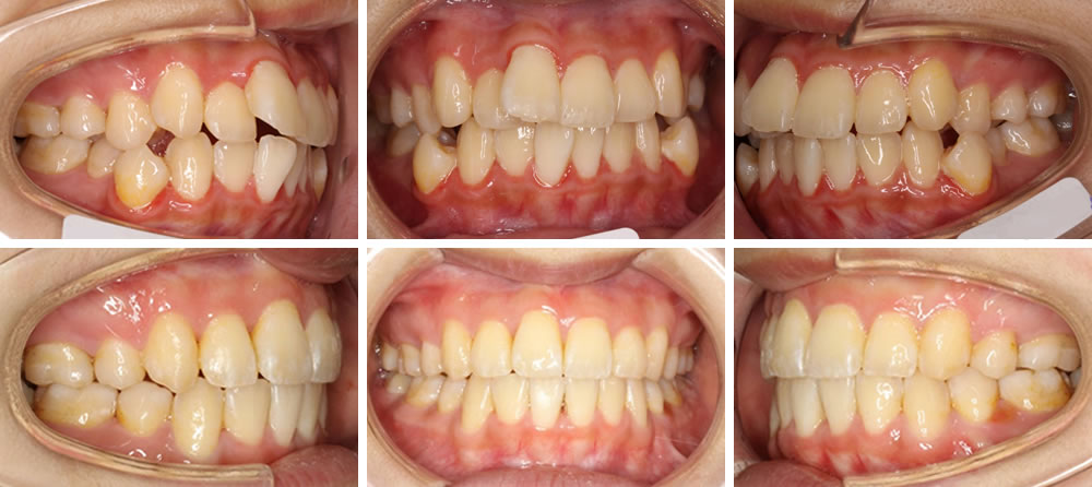 八重歯・叢生(デコボコの歯列)の矯正治療例