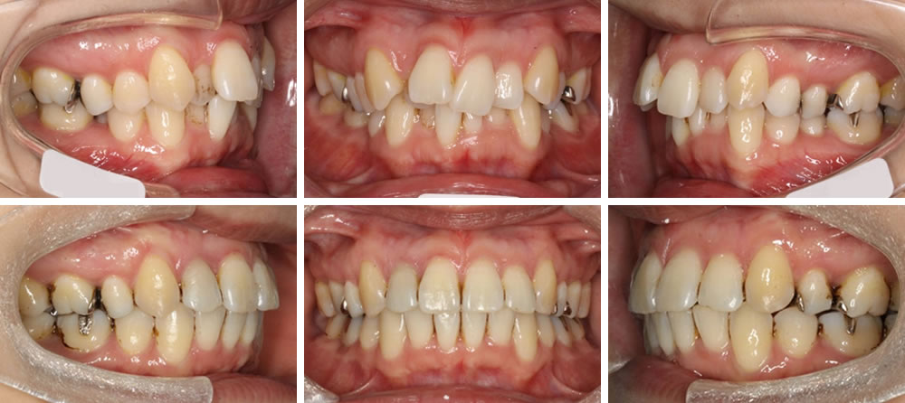 八重歯・叢生(凸凹の歯並び)の矯正治療例
