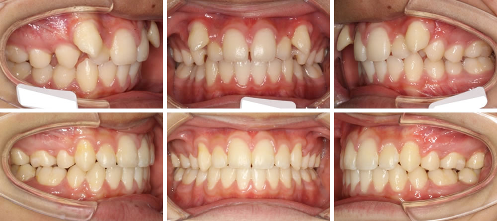 八重歯・叢生(凸凹の歯並び)の矯正治療例