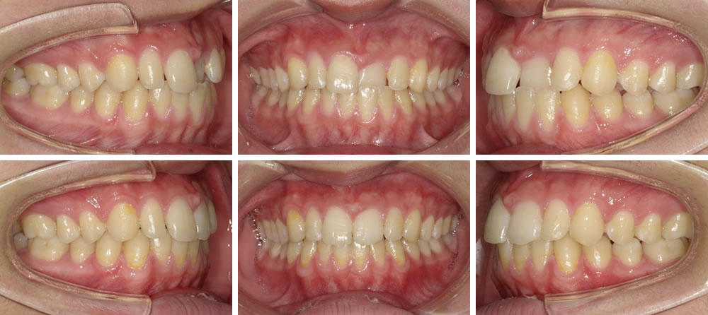 下顎前突(受け口)の矯正治療例