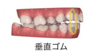 インビザラインと輪ゴム（顎間ゴム）2-④