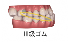 インビザラインと輪ゴム（顎間ゴム）2-②