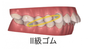 インビザラインと輪ゴム（顎間ゴム）2-①
