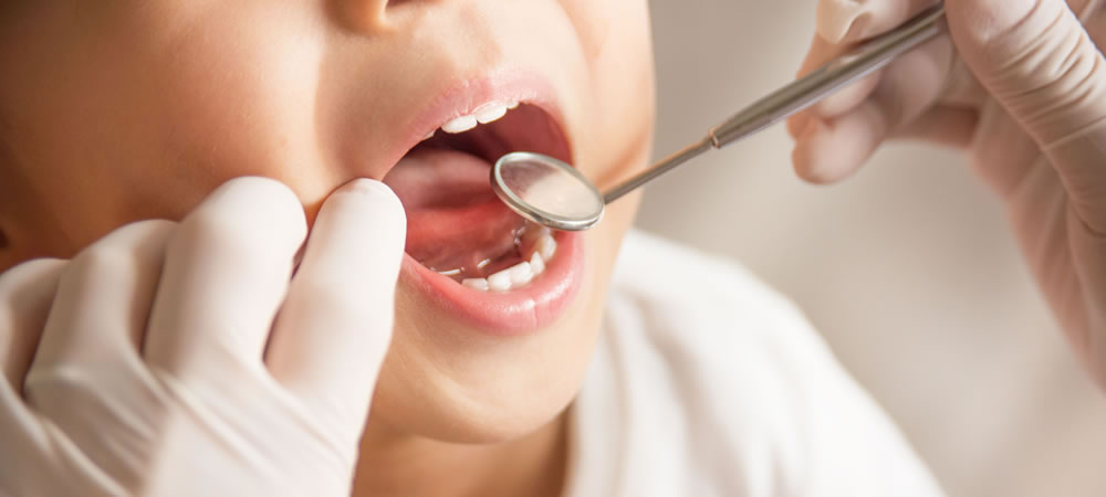 子供のすきっ歯の矯正治療