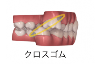 インビザラインと輪ゴム（顎間ゴム）2-③