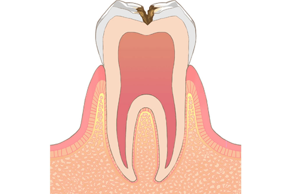 虫歯や歯周病