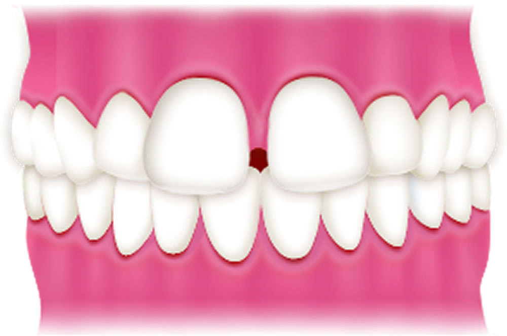 すきっ歯「空隙歯列」
