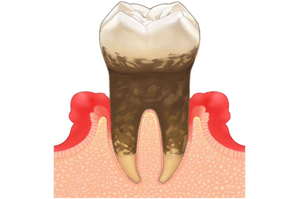 虫歯・歯周病リスクが高まる